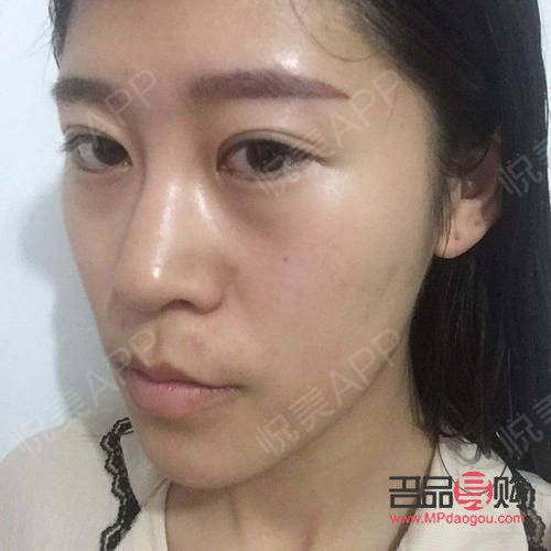 美容埋線怎么回事(美容埋線是怎么回事)
