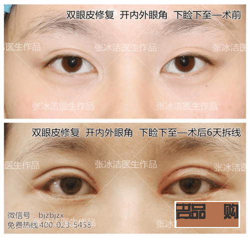 雙眼皮變成三眼皮是怎么回事(雙眼皮變成三眼皮是怎么回事玄學)