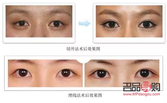 6D翹睫雙眼皮與埋線技術解析