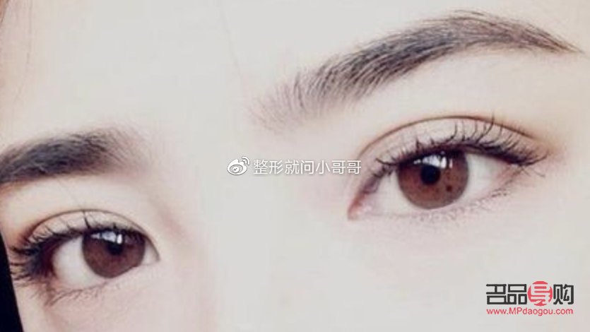 肉條雙眼皮是什么樣子？詳解雙眼皮類型與特征