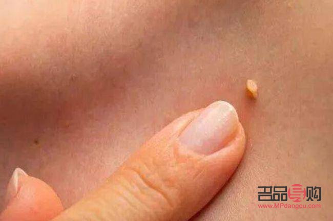 長疣怎么身體護理(長疣怎么身體護理最好)