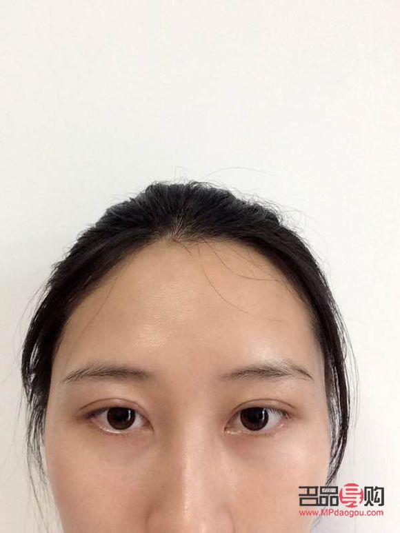 提肌的雙眼皮好難消腫(提肌的雙眼皮好難消腫怎么辦)