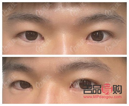 提肌的雙眼皮好難消腫(提肌的雙眼皮好難消腫怎么辦)
