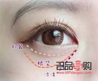 黑眼圈淚溝眼袋的區別圖片(黑眼圈眼袋淚溝圖片區分)