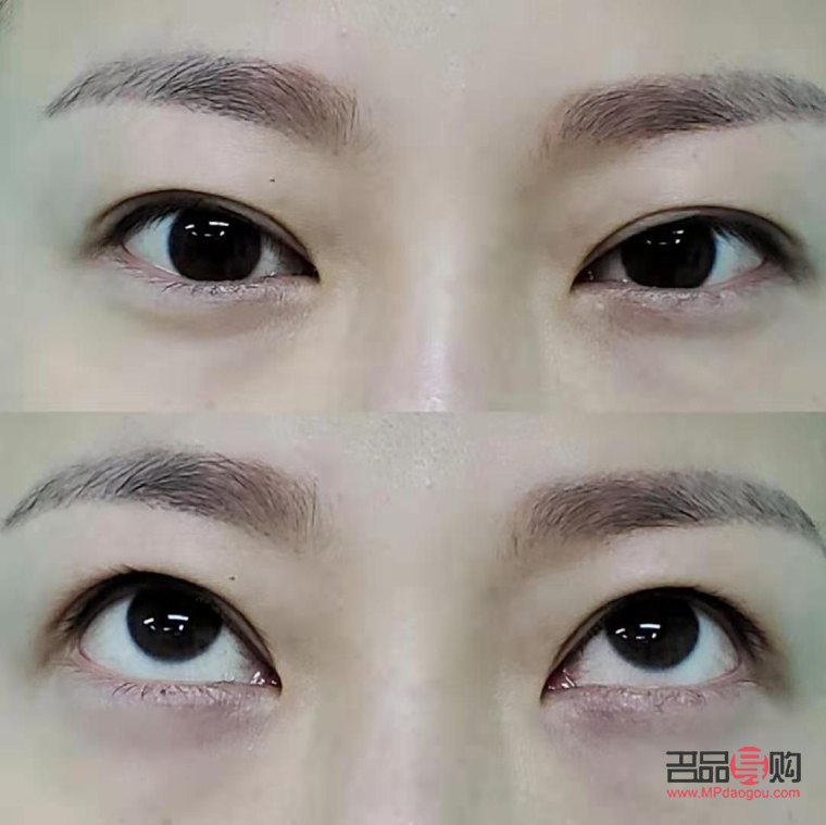 割雙眼皮對眼睛有什么影響(割雙眼皮對眼睛有什么影響嗎)