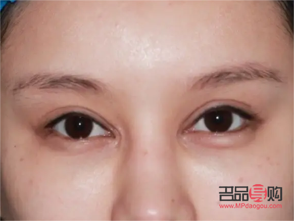 割雙眼皮對眼睛有什么影響(割雙眼皮對眼睛有什么影響嗎)