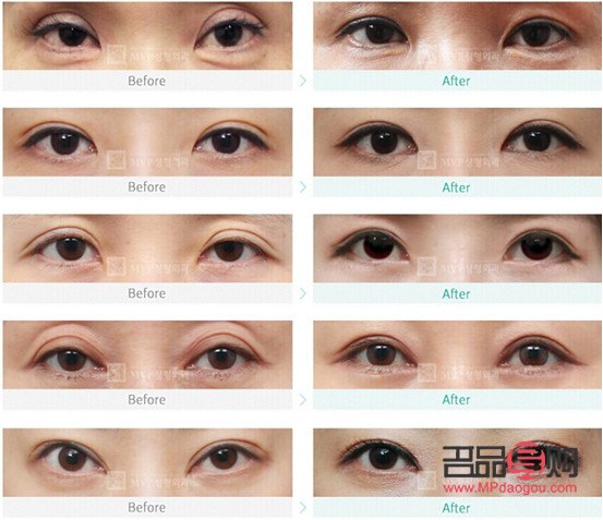 改變眼型：探索眼部整形的奧秘與美學