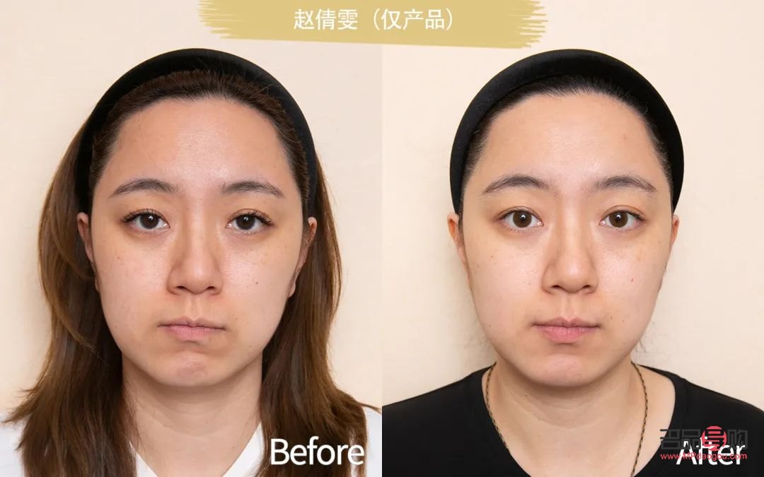 <h3>眼袋加淚溝綜合手術多少錢？全面解析手術費用及影響因素</h3>