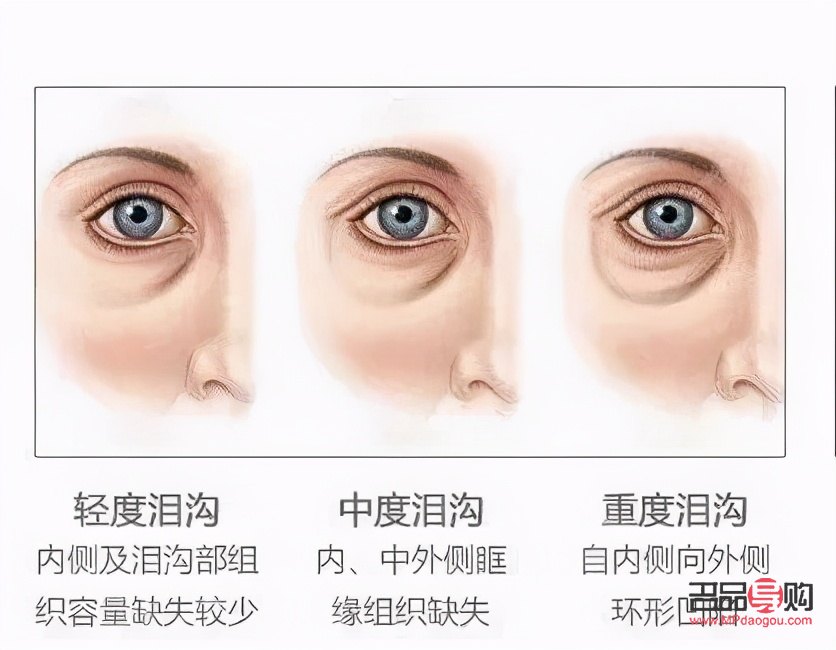 眼袋加淚溝綜合手術多少錢？全面解析手術費用及影響因素