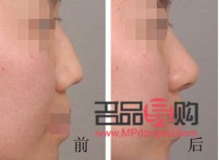 手術美容線多少錢(手術美容線多少錢一根)