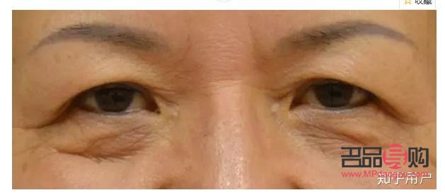 探究上眼皮松弛嚴重問題及其解決方案