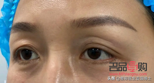 探究上眼皮松弛嚴重問題及其解決方案