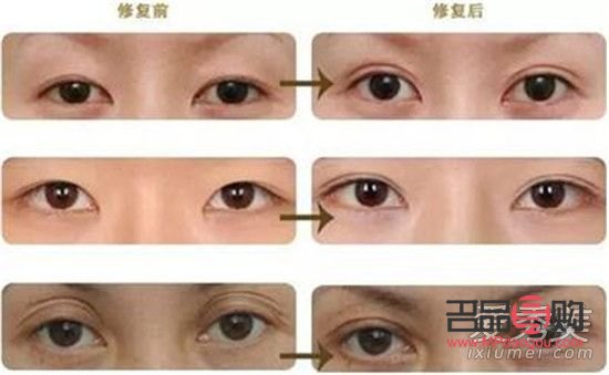 <h3>雙眼皮做窄了能修復嗎？</h3>