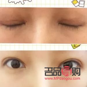 <h3>大小眼可以割雙眼皮嗎</h3>