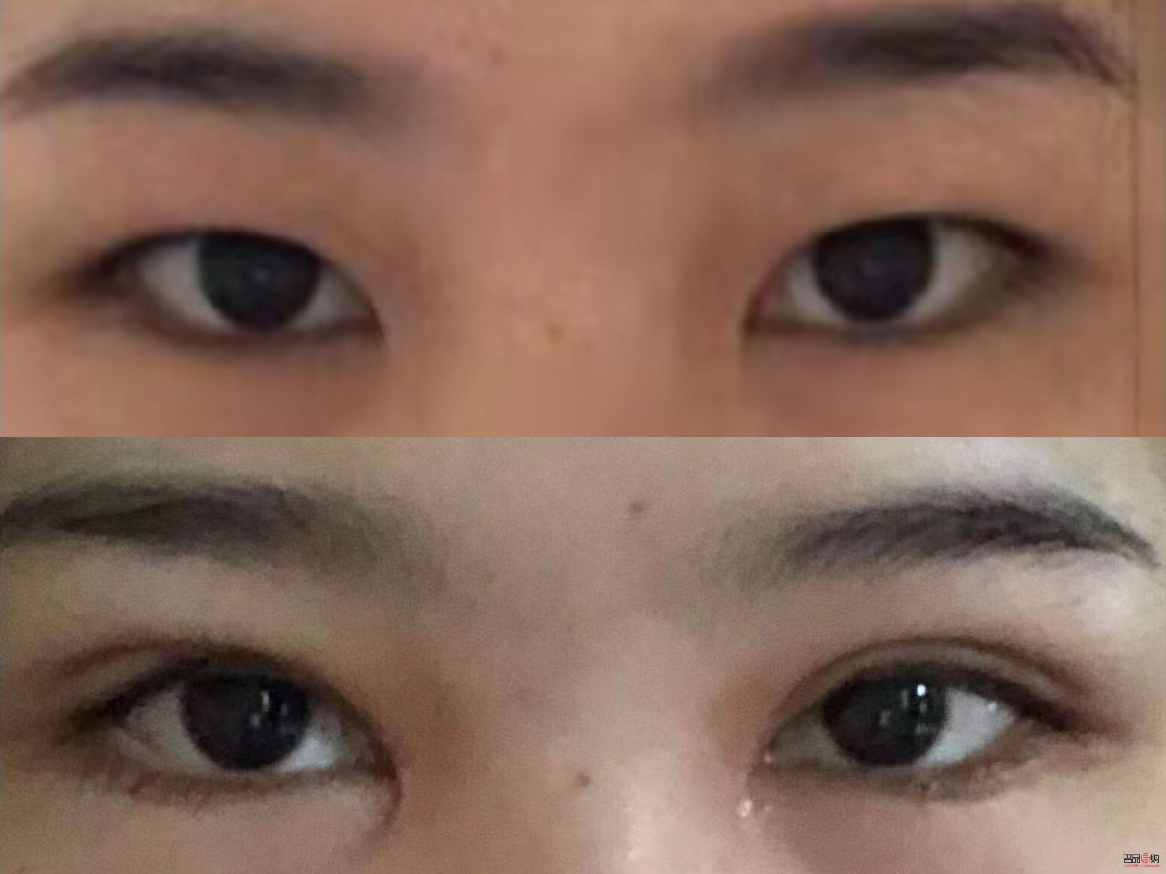 大小眼可以割雙眼皮嗎