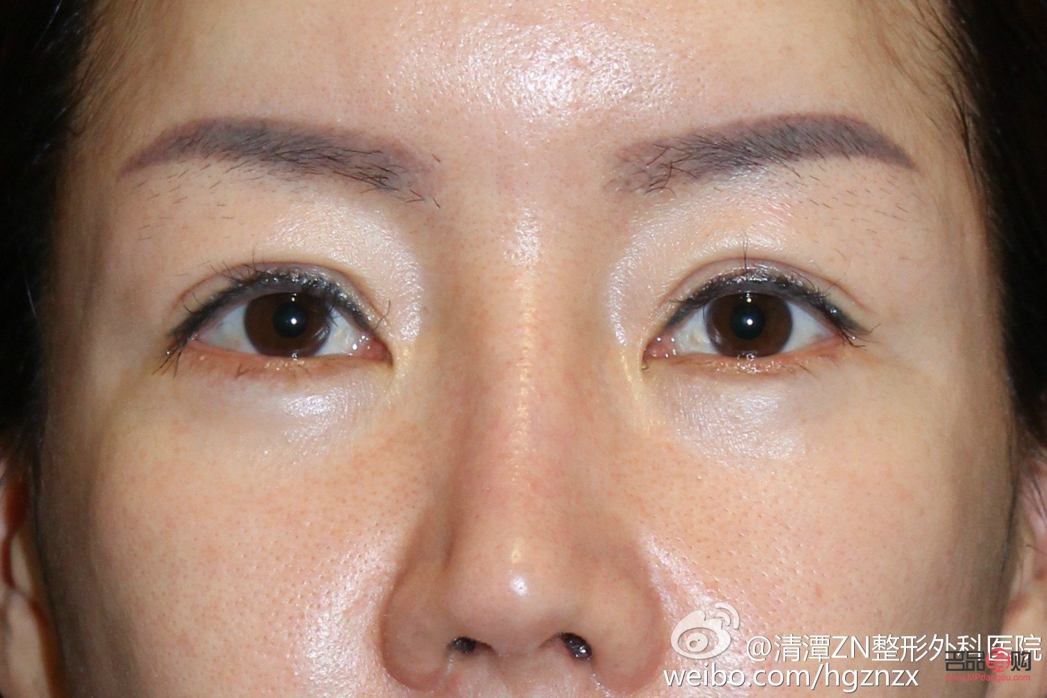 眼角下垂怎么提升和緊致眼角
