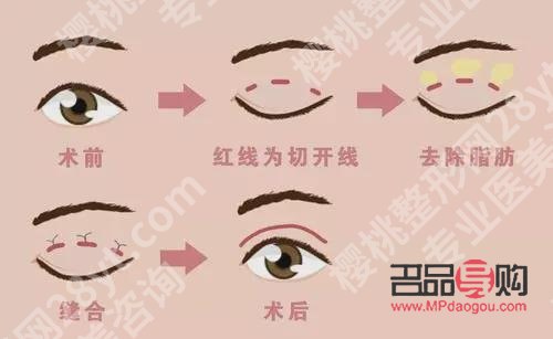 <h3>雙眼皮二次修復最佳時間：師麗麗專業解讀</h3>