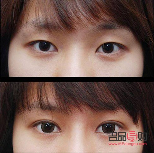雙眼皮手術與自然雙眼皮對比(雙眼皮手術與自然雙眼皮對比)
