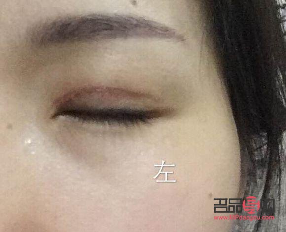 全切雙眼皮多久能恢復正常顏色