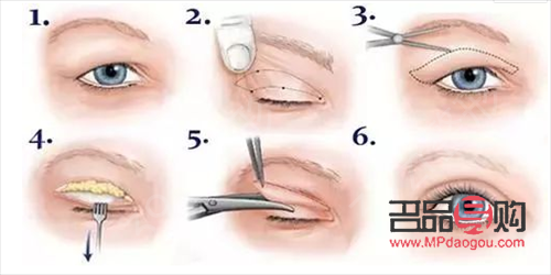 雙眼皮手術(shù)哪里做的比較好？專業(yè)醫(yī)院與美容機(jī)構(gòu)大比拼！