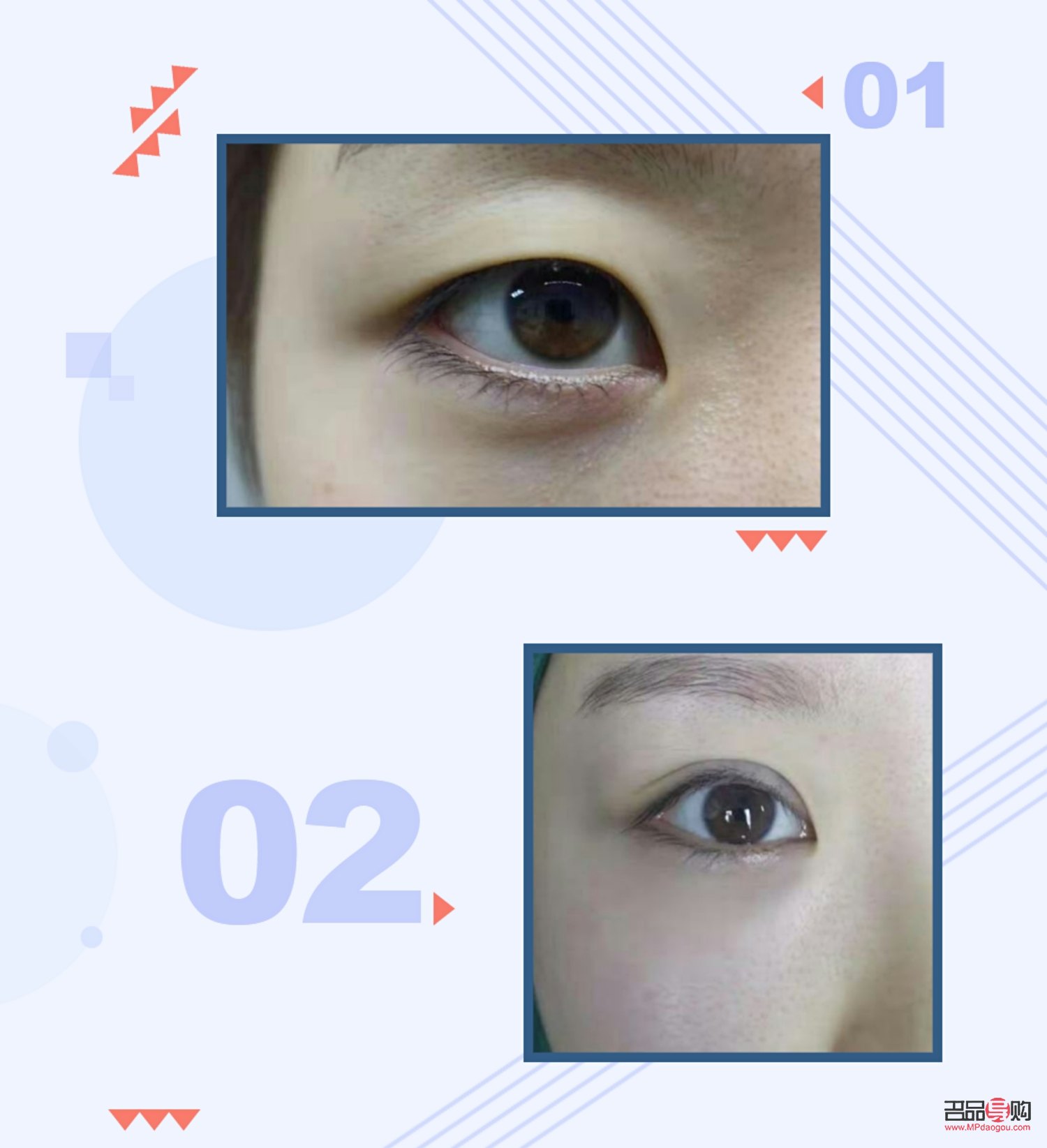 割雙眼皮手術多久恢復(割雙眼皮手術多久恢復正常)