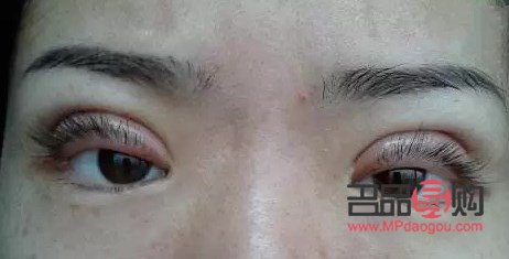 <h3>雙眼皮失敗的幾率探究</h3>