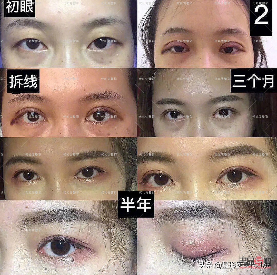 <h3>全切雙眼皮修復手術費用詳解</h3>