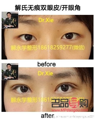 <h3>多層眼皮是否適合進行雙眼皮手術？</h3>