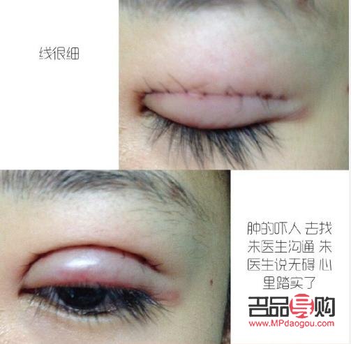 埋線跟全切雙眼皮哪個好(埋線跟全切雙眼皮哪個好點)
