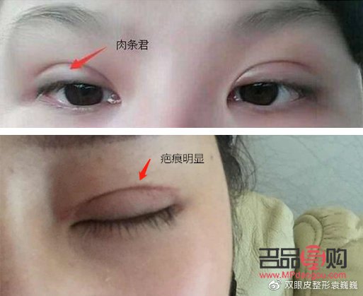 埋線跟全切雙眼皮哪個好(埋線跟全切雙眼皮哪個好點)