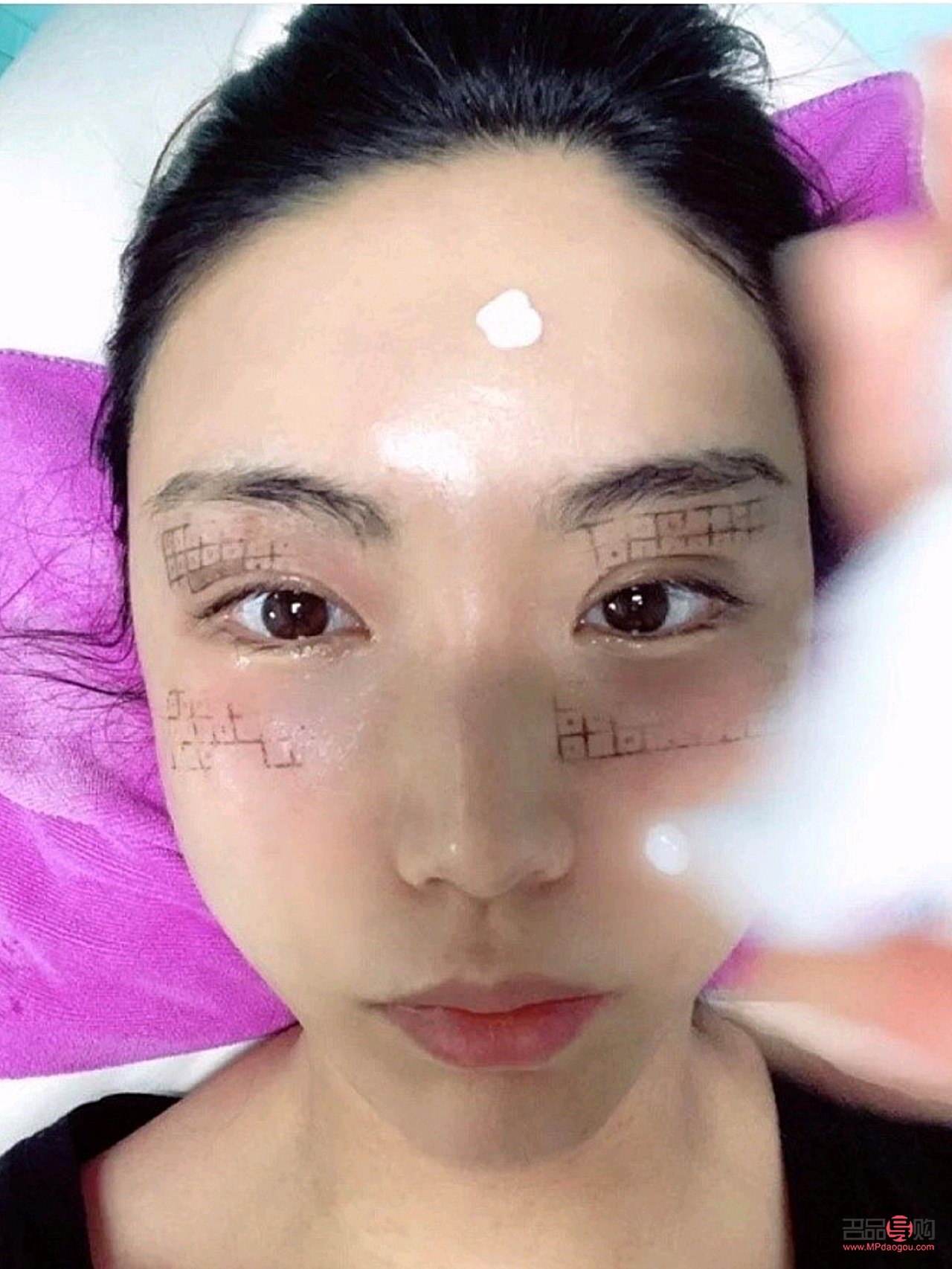 眼部熱瑪吉有恢復期嗎(眼部熱瑪吉多久恢復)