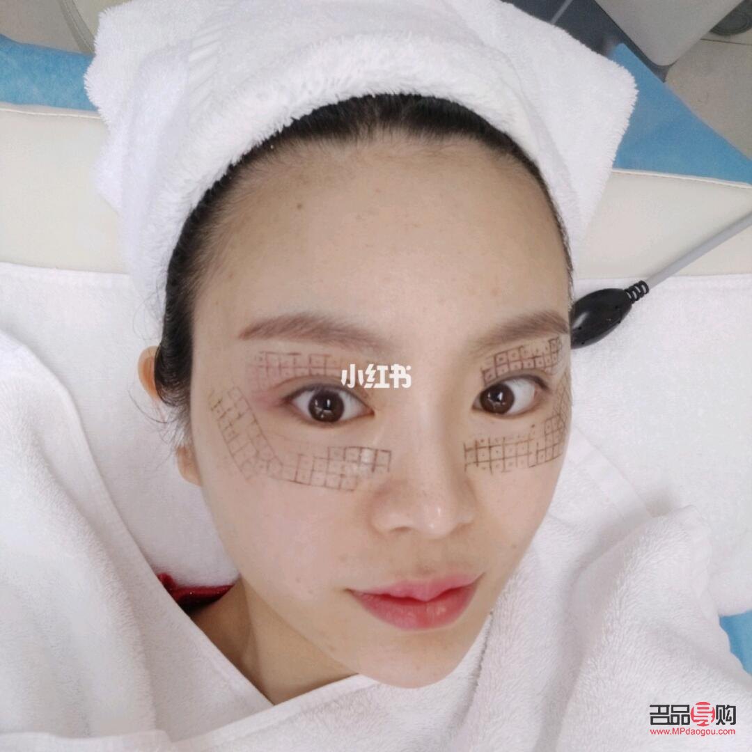 眼部熱瑪吉有恢復期嗎(眼部熱瑪吉多久恢復)