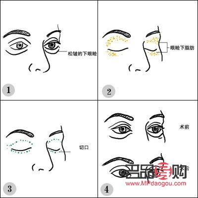 給眼皮抽脂要多少錢？全面解析眼皮抽脂價格因素