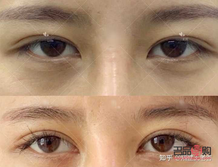 眼距寬割雙眼皮時是否需要開眼角？