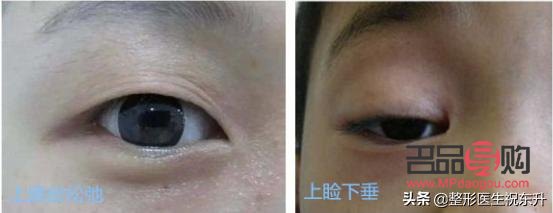 眼皮松弛下垂手術(shù)前后對(duì)比照片(眼皮松弛下垂手術(shù)多長時(shí)間恢復(fù))