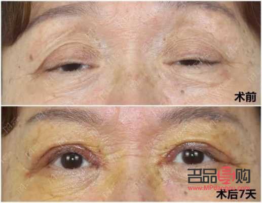 眼皮松弛下垂手術(shù)前后對(duì)比照片(眼皮松弛下垂手術(shù)多長時(shí)間恢復(fù))