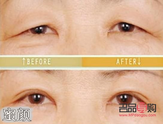 眼皮松弛下垂手術(shù)前后對(duì)比照片(眼皮松弛下垂手術(shù)多長時(shí)間恢復(fù))