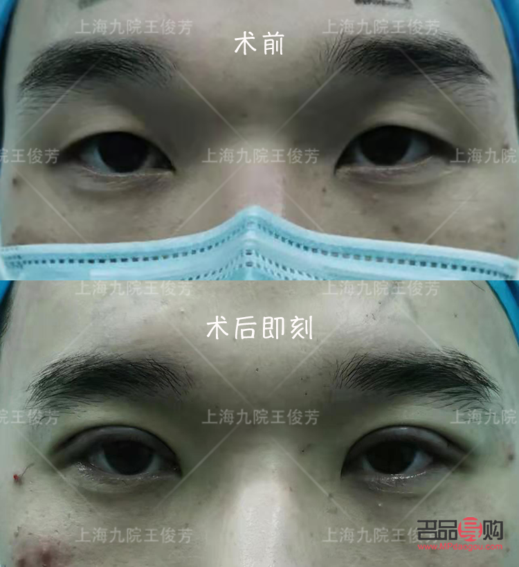 <h3>現(xiàn)在流行做什么樣的雙眼皮</h3>
