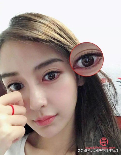 <h3>雙眼皮增生圖片解析與應對方法</h3>