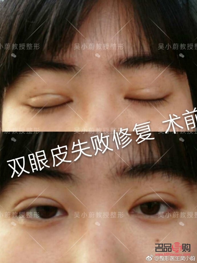 <h3>雙眼皮增生圖片解析與應對方法</h3>