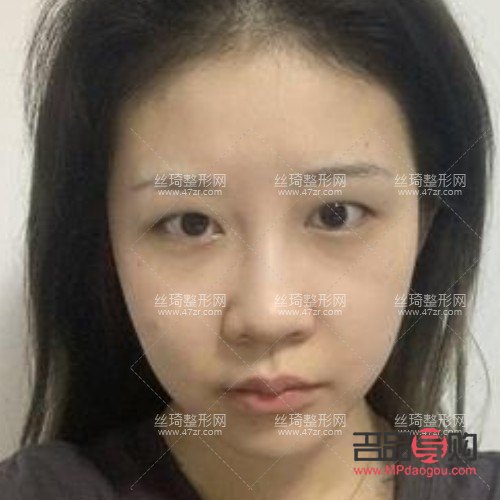 全切雙眼皮手術：塑造明亮雙眼的優選方案