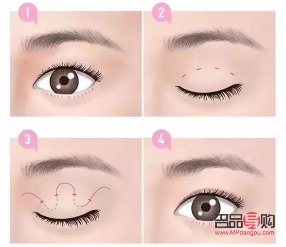 <h3>一單一雙可以做雙眼皮手術(shù)嗎？</h3>
