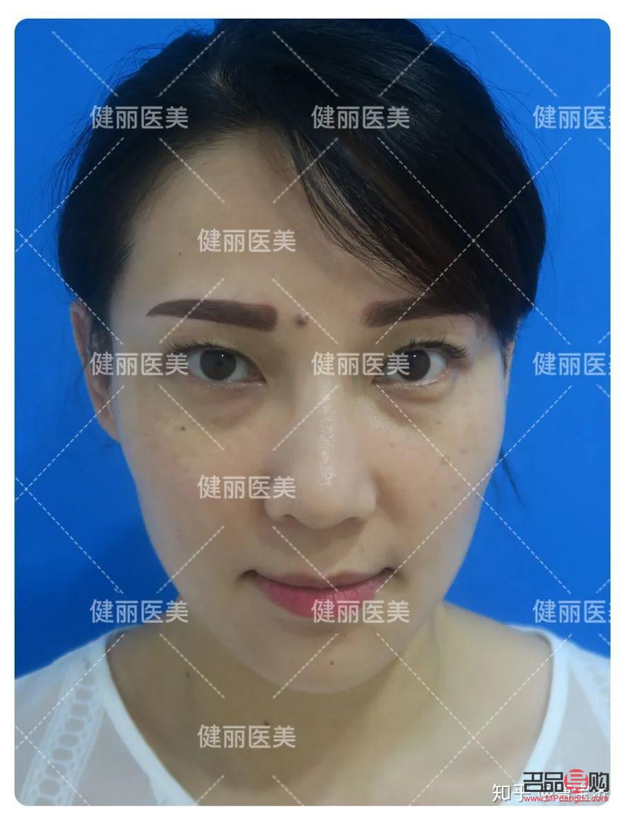 <h3>15歲有眼袋怎么辦才能消除</h3>