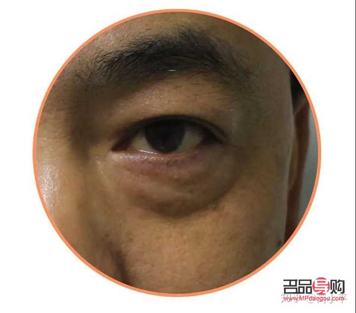 <h3>15歲有眼袋怎么辦才能消除</h3>