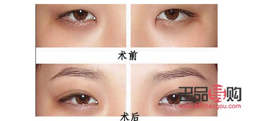 做什么雙眼皮最好(做什么雙眼皮最好看)