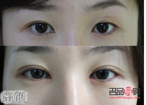 微創雙眼皮10天恢復圖(微創雙眼皮10天恢復圖片大全)