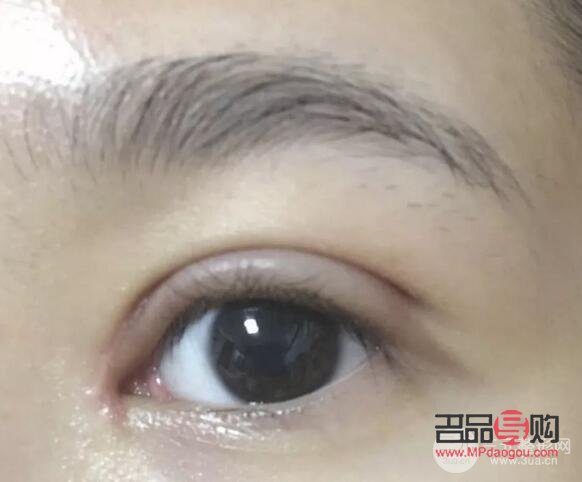 微創雙眼皮10天恢復圖(微創雙眼皮10天恢復圖片大全)