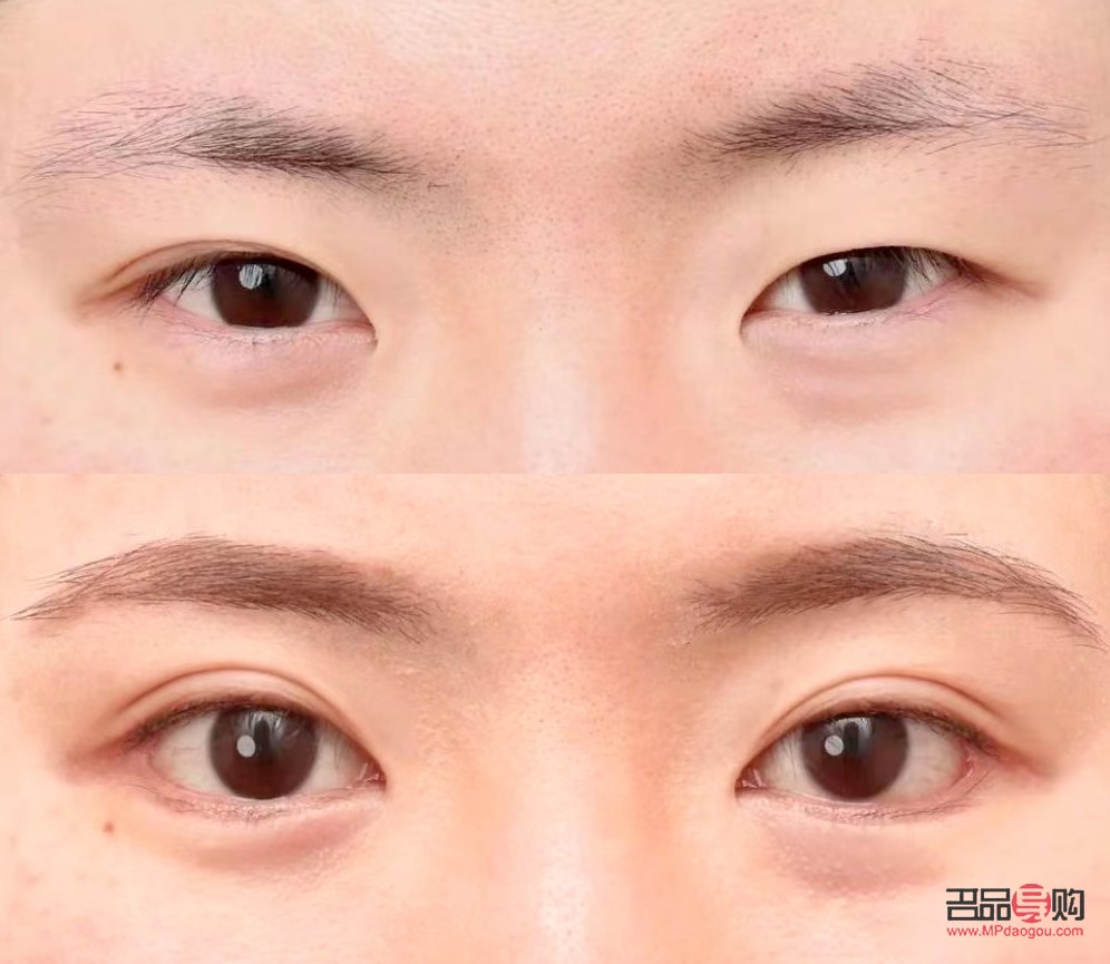 一單一雙眼皮怎么改善不割(一單一雙眼皮怎么矯正除了手術)