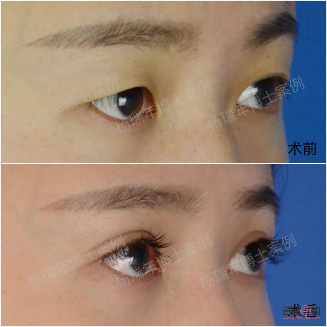 一單一雙眼皮怎么改善不割(一單一雙眼皮怎么矯正除了手術)