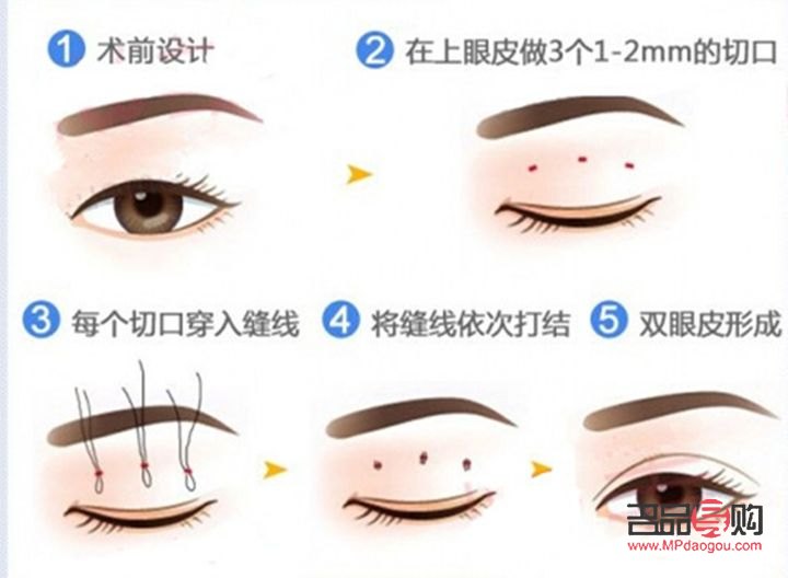 雙眼皮修復(fù)并非重新做一次，而是精細(xì)化調(diào)整